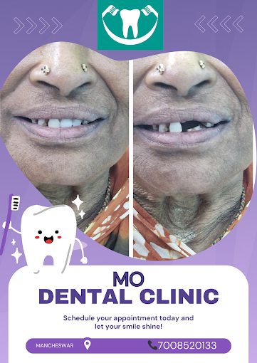 Prosthetic smile makeover results at MO Dental Clinic