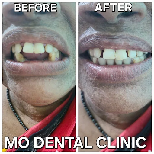 Scaling Before & After Transformation at MO Dental Clinic