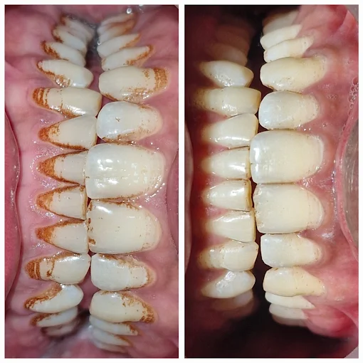 Deep Cleaning scaling before and after at MO Dental Clinic