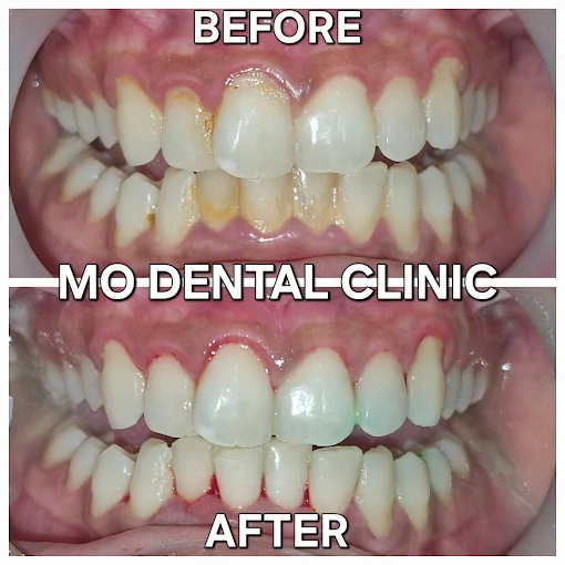 Gum recovery scaling results at MO Dental Clinic